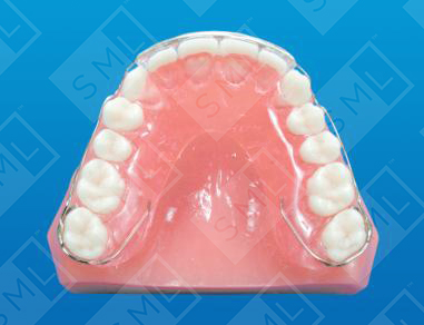 Wrap Around Retainer_0
