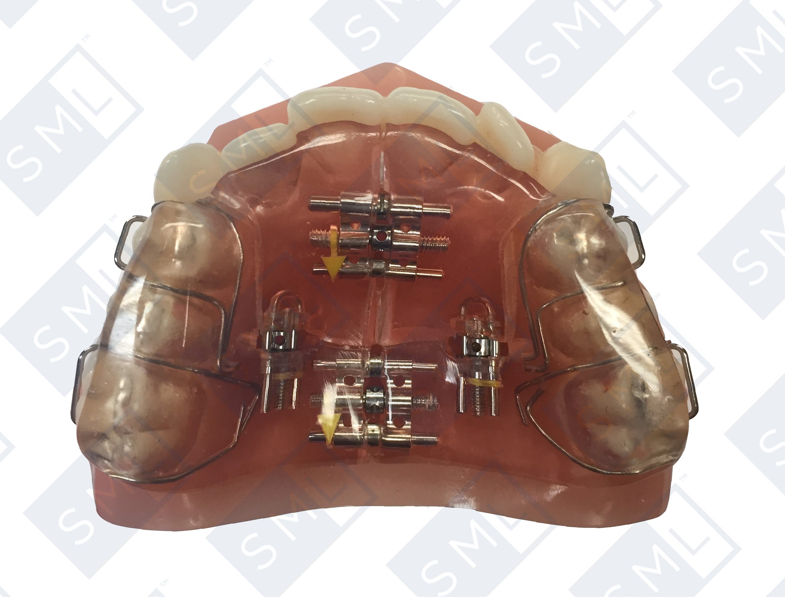 four-screw-sagittal