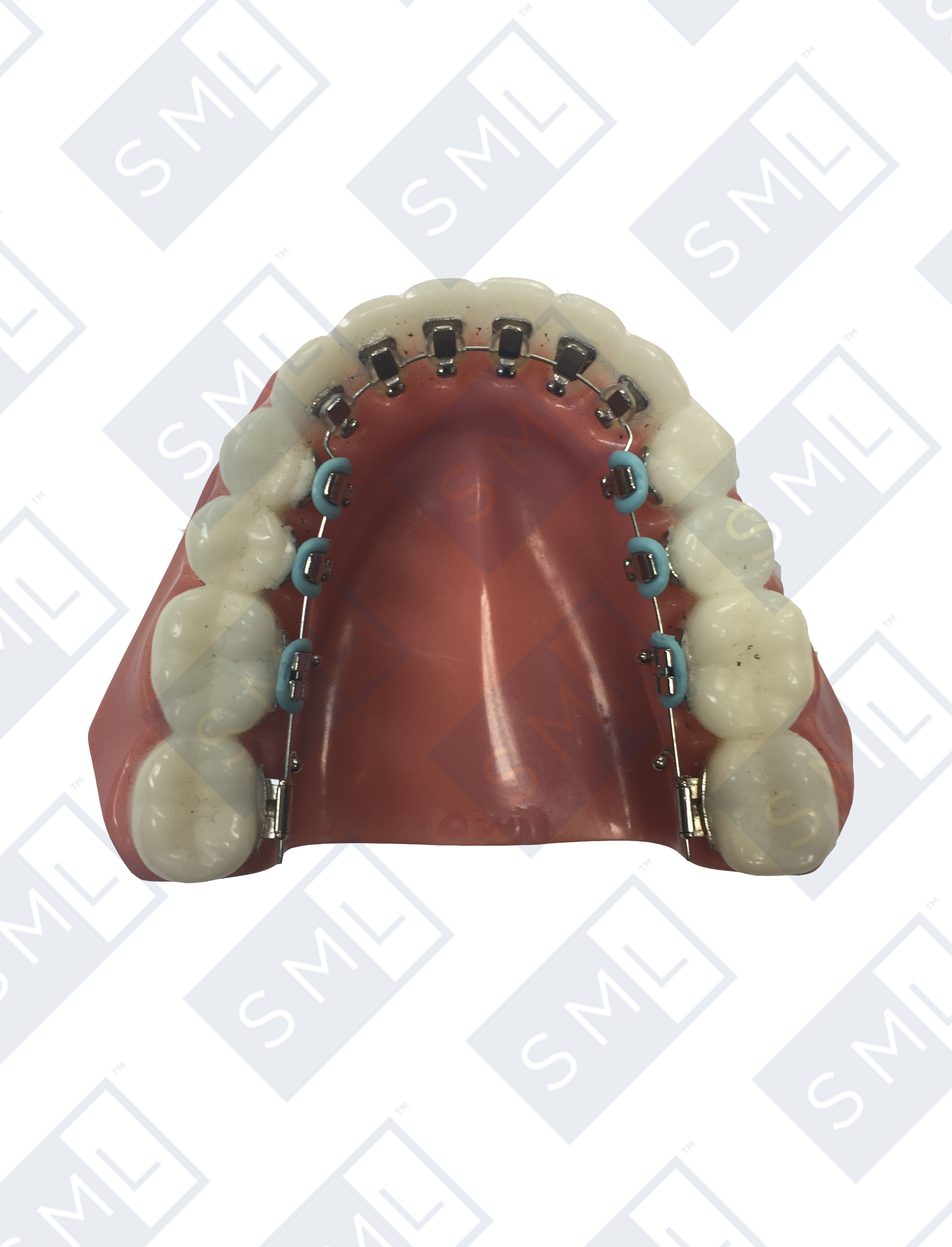 lingual-brackets-lower