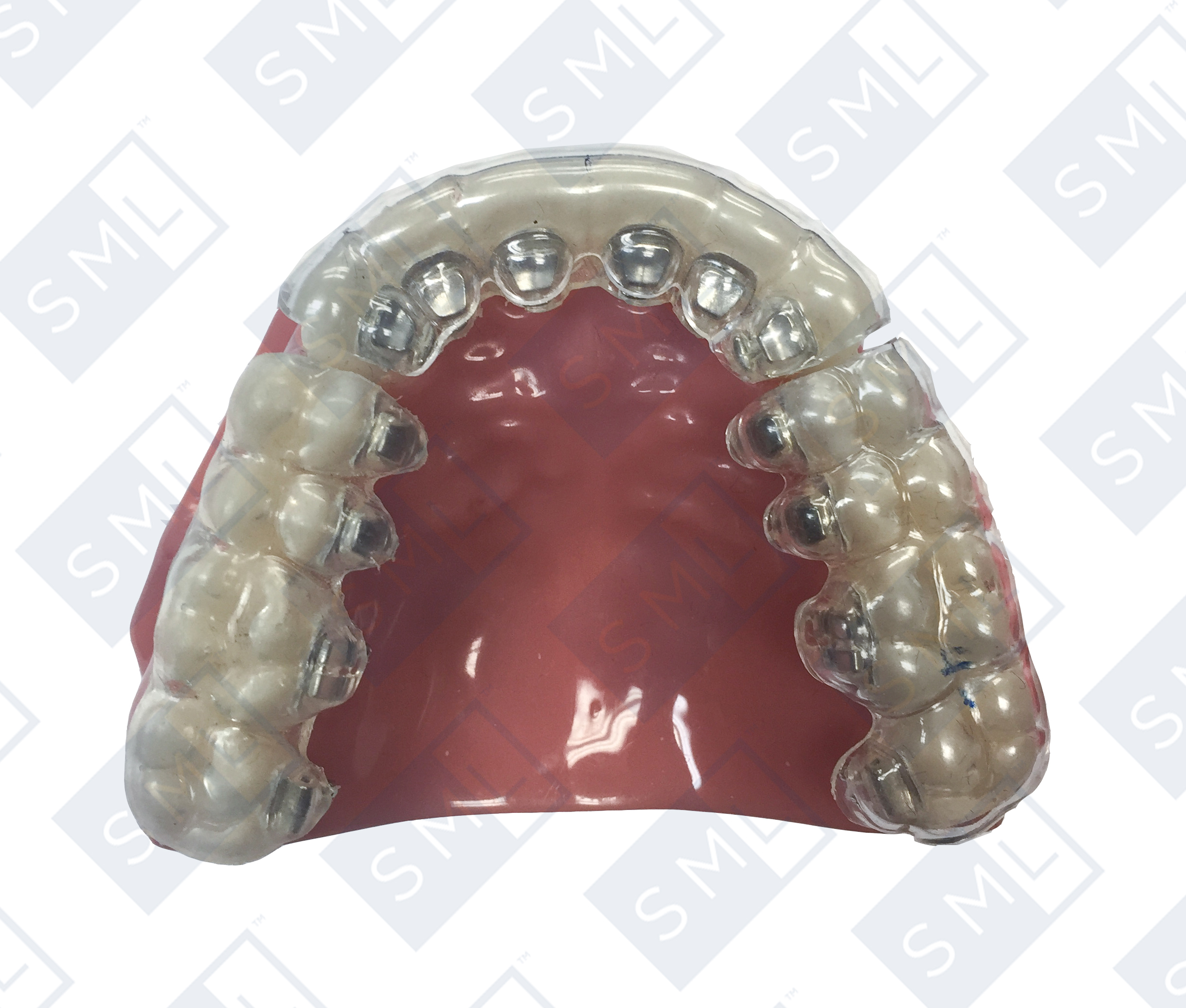 lingual-brackets