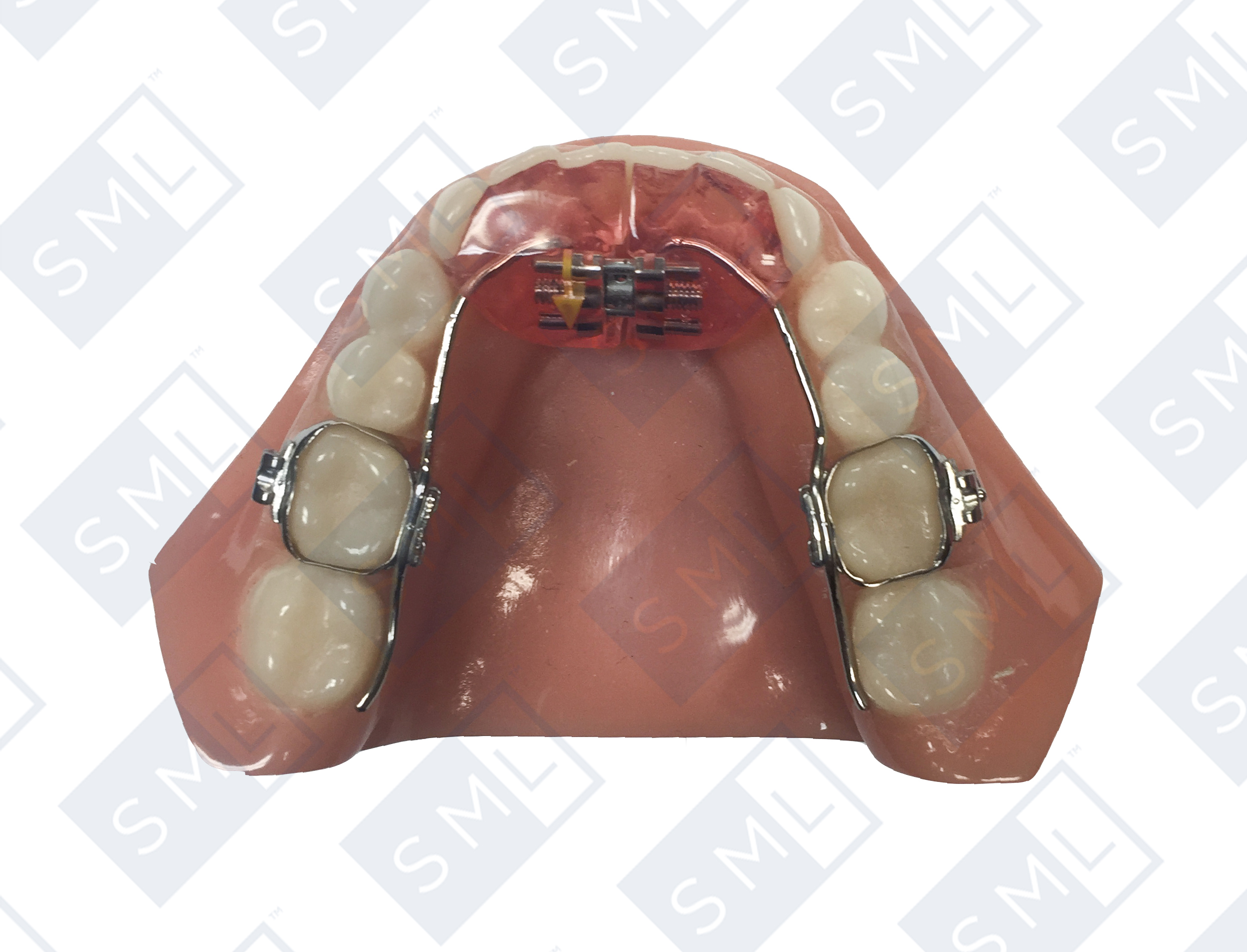 lower-skeletal-expander