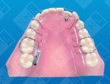 Buccal Molar Uprighting_0_0_0