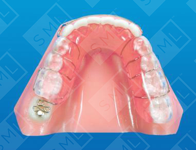 Removable Ectopic Dist_0_0