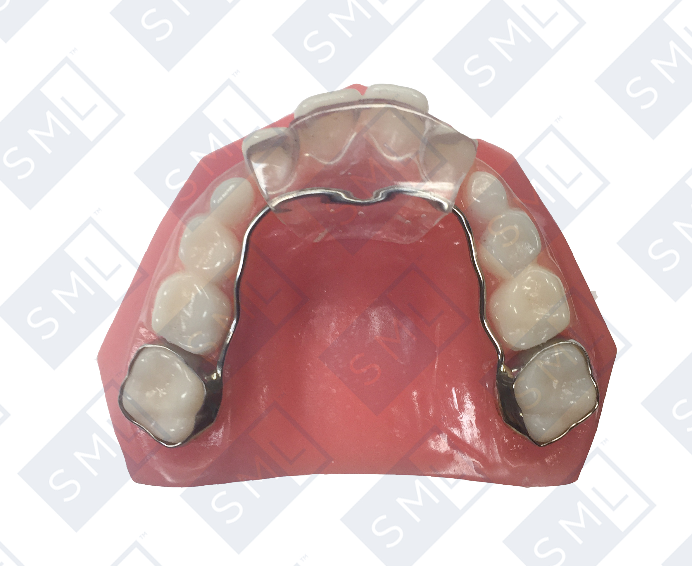 fixed-anterior-bite plane