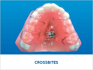 Crossbites_0
