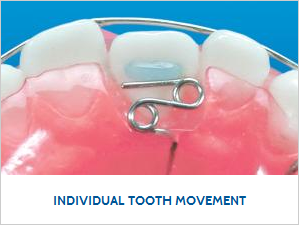 Individual Tooth Movement_0