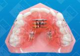 hree Screw Sagittal