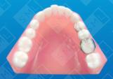 Banded Bonded Interim Splint