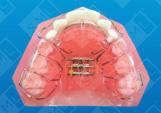 Bilateral Crossbite
