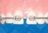 Diastema Closing_0