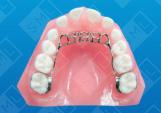 Fixed Tongue Loops_0