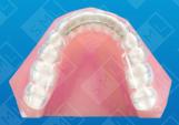 Mandibular Bruxism Splint