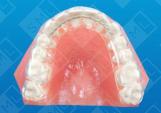 Maxillary Horseshoe Splint