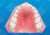 Mesial and Lingual Anterior Movement_0