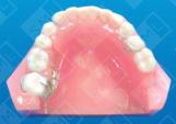 Molar Uprighting Treatment Partial