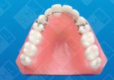 Palate-Free Temp Removable Partial Denture_1.jpg