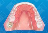 Removable Ectopic Dist_1