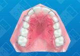 Removable with Anterior Finger_0