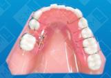 Removal Space Regainer_0