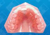 Single Tooth Anterior Crossbite with Bite Plane_0.jpg