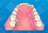 Single Tooth Molar Uprighter_0
