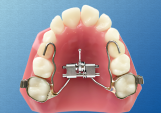 Mixed-Dentition-2-Arm-Design